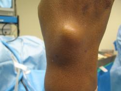 Tumors