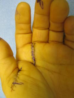 Trigger Finger